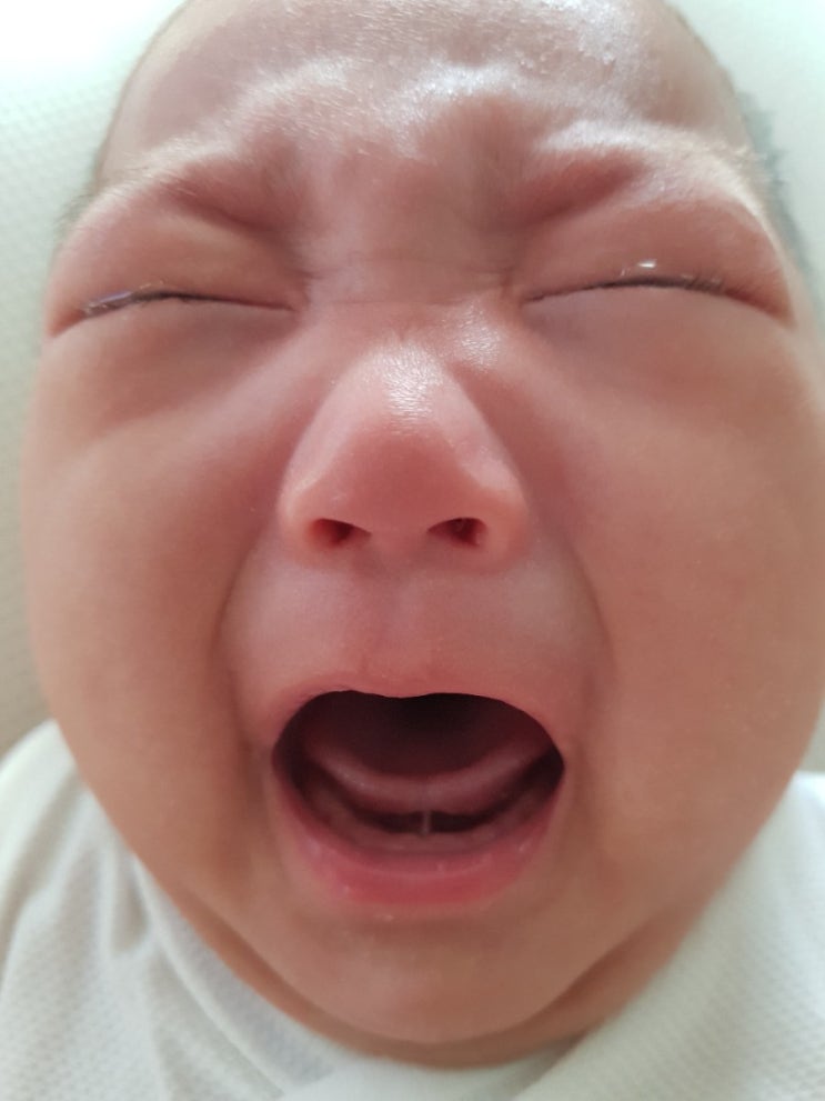  신생아 설소대시술 후기(d+109일 시술)
