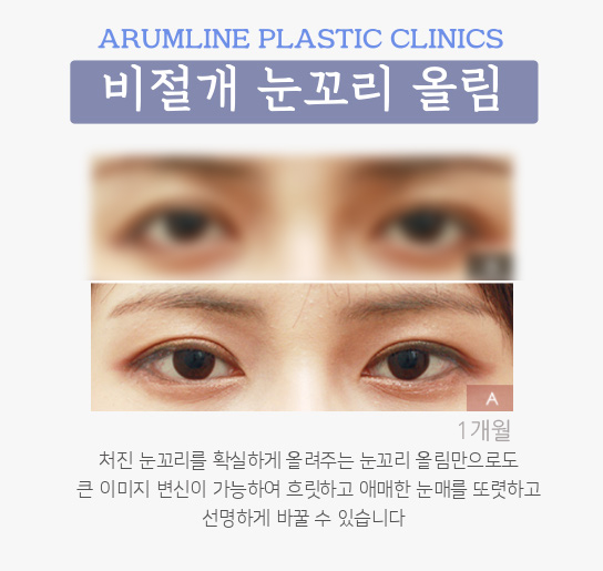 섹시한 눈을 원한다면 쌍꺼풀 리프팅 수술 5