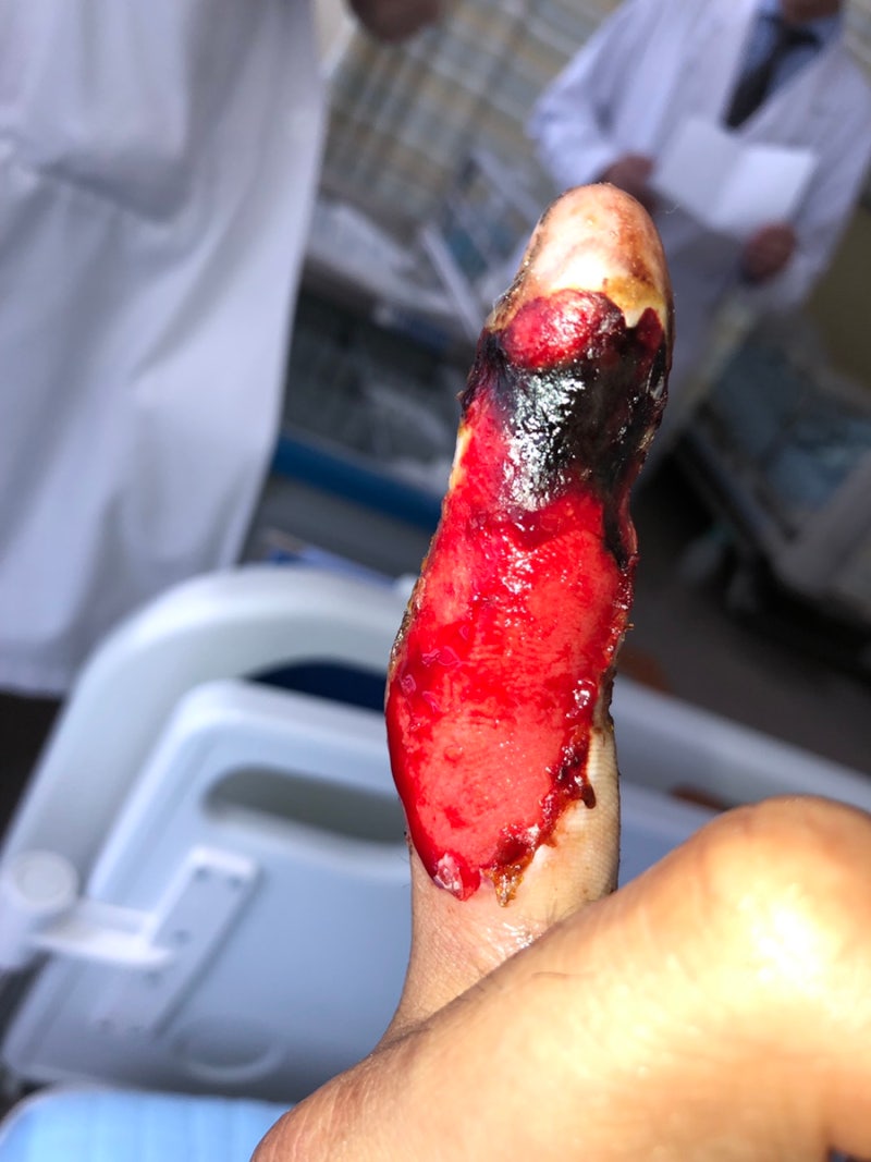 혐주의)뱀조심! 쇠살모사(Snake bite) 치료기 3부 : 네이버 블로그, image size:800x1067