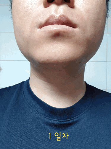  [강서구왁싱/마곡왁싱/발산역왁싱]나혼자산다 조병규왁싱, 턱수염왁싱 1일차부터 14일차 후기