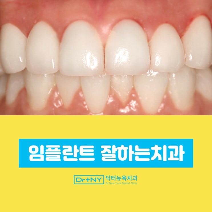  임플란트 잘하는 치과의 특징 4가지
