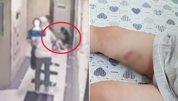  불쌍하다는 이유로 견주가 '입마개' 안 씌워 3살 여아 허벅지 물어뜯은 폭스테리어