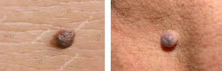  [목동 신정동 신월동 피부과 앤클리닉] 튀어나온 점빼기!! 진피내 모반(Intradermal nevus)
