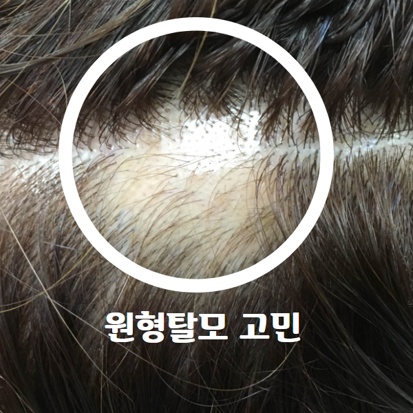  원형탈모 치료 원인?머리땜빵 메이시크후기