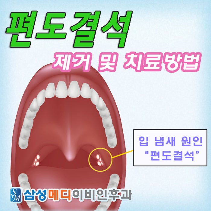 편도결석 제거 및 치료방법 궁금하시죠? [부산역 이비인후과]