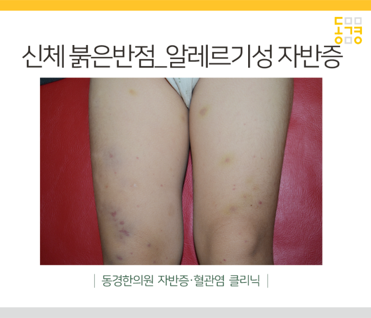  몸에 붉은 반점, 단순 피부질환일까 자반증일까?
