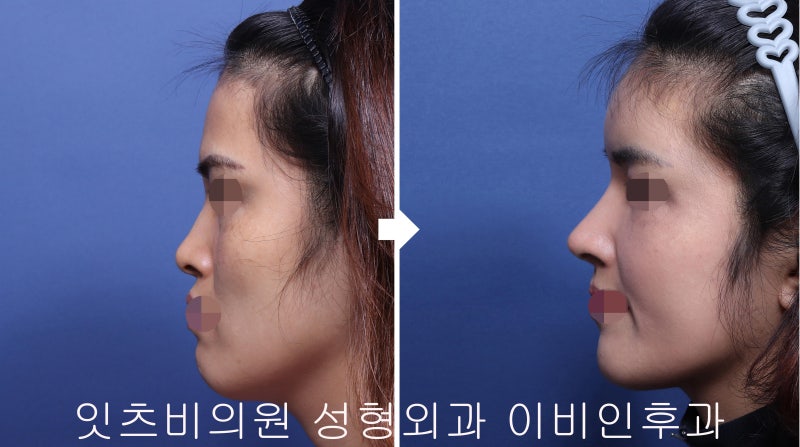 얼굴 지방 이식의 부작용을 녹이기 위한 치료는? 6