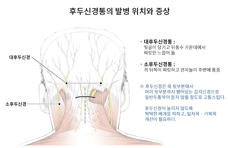후두 신경통 증상, 원인 및 치료 후두부에 따끔 거림