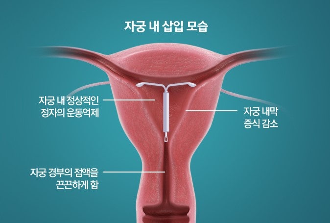 지옥의 생리통, 밀레나 시술 후 5개월 (상태변화,장단,단점,비용)
