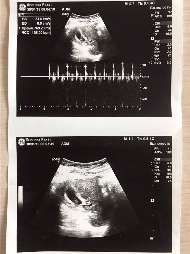  [임신2개월] 임신8-9주차 두번째 입원