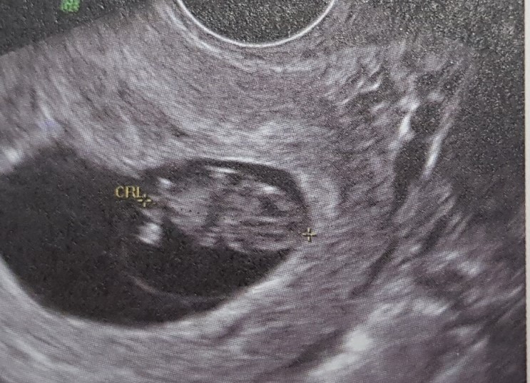 임신8주 아기 심장소리와 둘째맘이 겪은 증상들