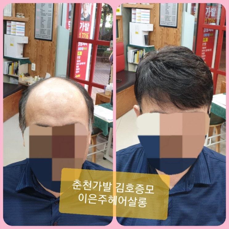  춘천가발 탈모자가진단법 정기적인가발관리로 가발수명늘리기