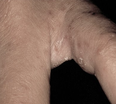 남자 성병 피부병 종류와 증상 : 네이버 블로그