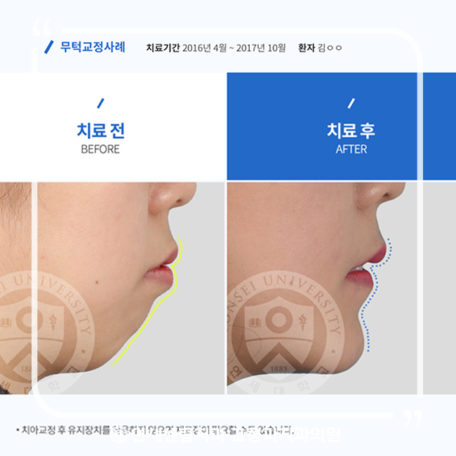  센텀교정전문치과  연세센텀치과의 특별한 무턱교정!