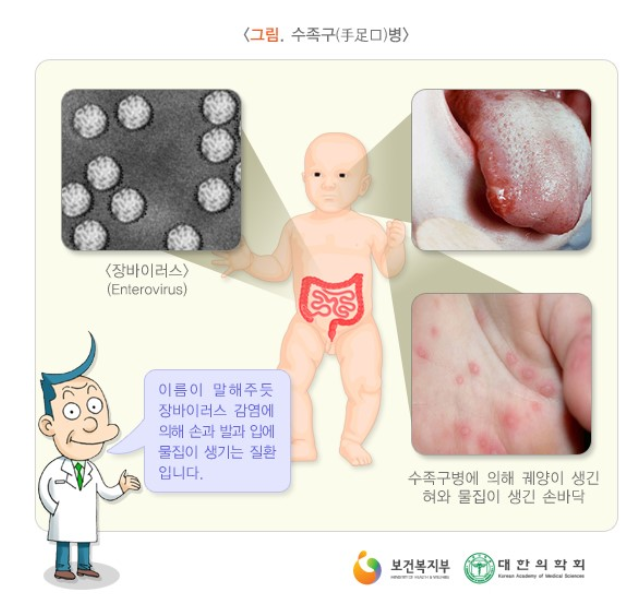  수족구병 치료, 예방, 전염성, 콕사키바이러스