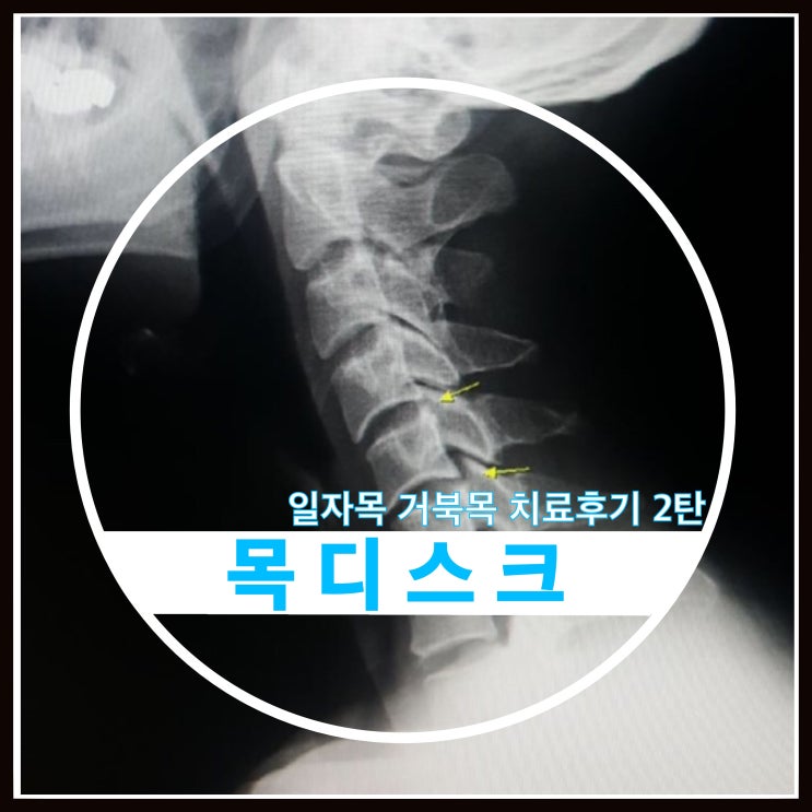 목디스크 투병일기 치료후기(일자목,거북목) 2편