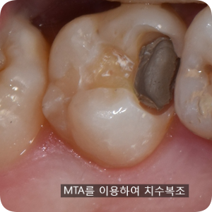  신경까지 도달한 충치 / MTA를 이용한 이맥스 인레이