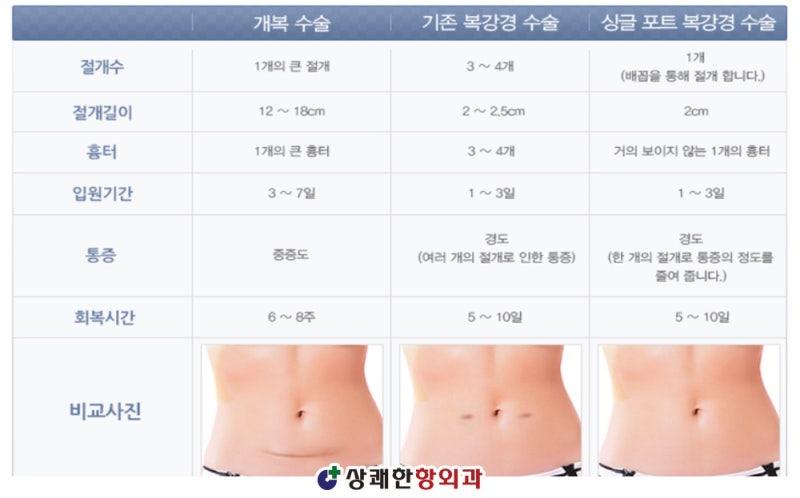 안양복강경 충수절제술