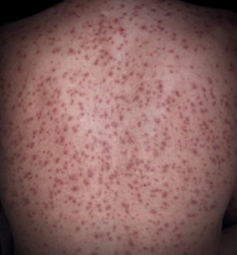 남성에서 피부병을 일으킬 수 있는 성병 : 네이버 블로그 남성에서 피부병을 일으킬 수 있는 성병 : 네이버 블로그