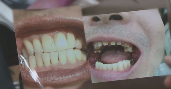 치아가 모두 갈린 80여 명의 환자 '공포의 치과의원' (오늘 궁금한 이야기Y 주요 내용 미리보기)