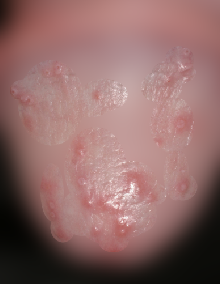 귀두 붉은 반점의 원인- 칸디다 귀두염의 증상, 검사와 치료 : 네이버 블로그