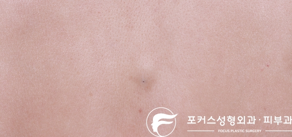  [부천성형외과 Dr. 김 칼럼] 등에 난 피지낭종