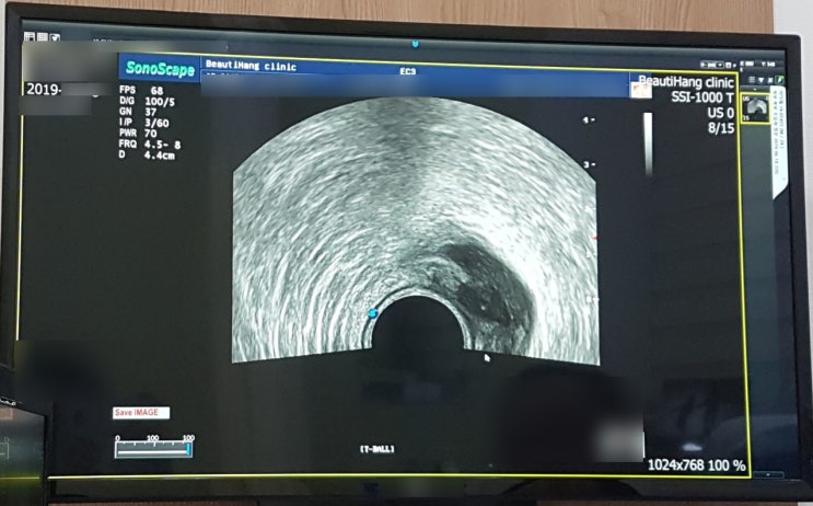  항문직장농양이 걸리기까지 ...