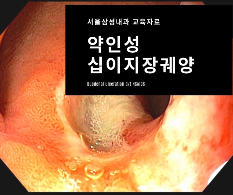 진통제나 아스피린에 의한 위, 십이지장 궤양의 발생과 헬리코박터균과의 상관성, 치료에 관한 교육자료 - 광주 위내시경 잘하는 서울삼성내과