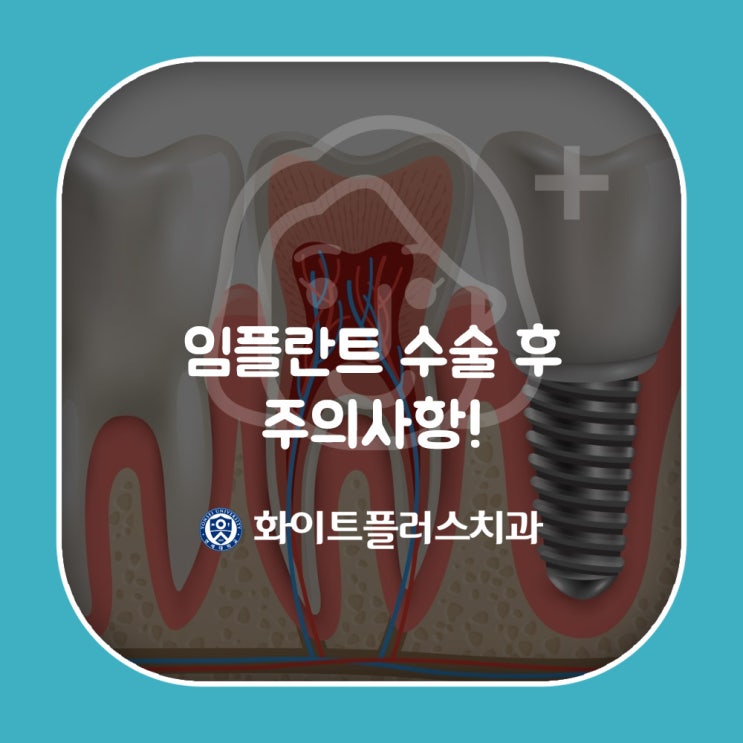  [신대방동]임플란트 수술 후 주의사항