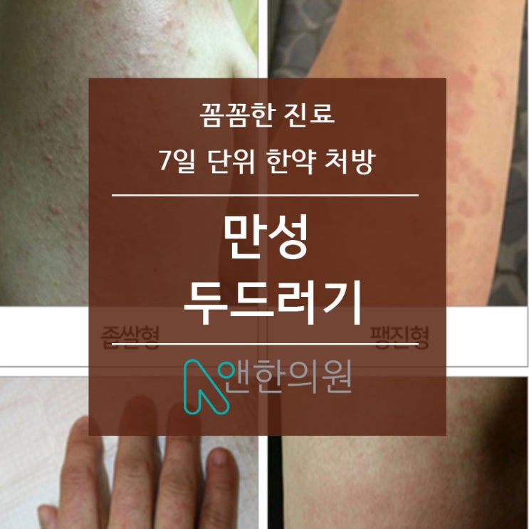  만성 두드러기 항히스타민제만으로는 어렵습니다 -수원 두드러기 치료