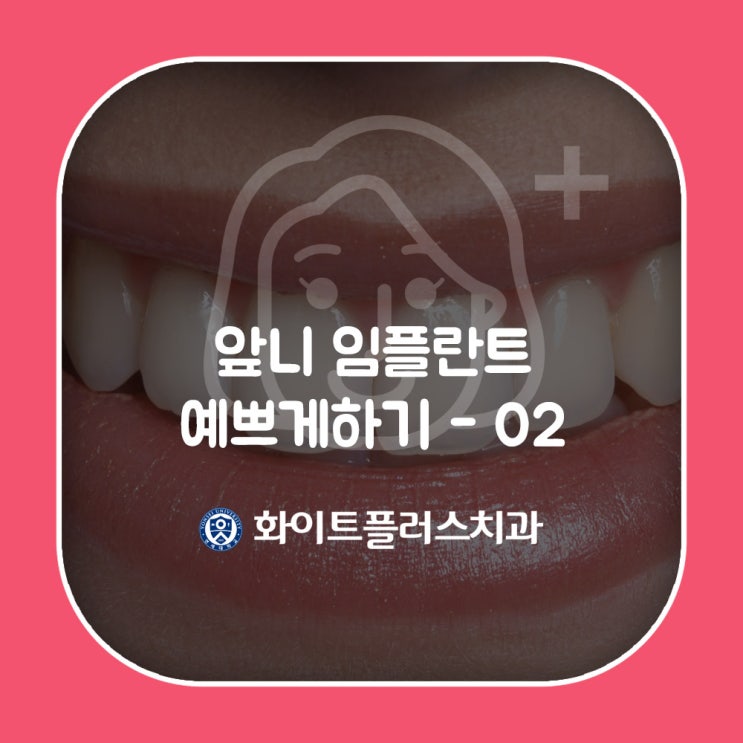  [신길동 치과] 앞니 임플란트 예쁘게 하기 -2