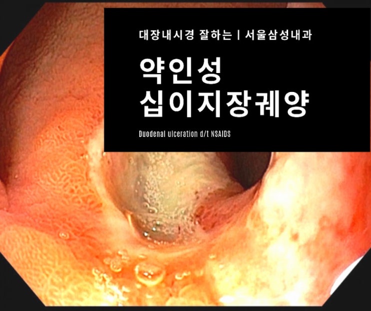  진통제복용 후 복통으로 발견된 십이지장 궤양 1례 - 광주에서 위내시경 잘하는 서울삼성내과