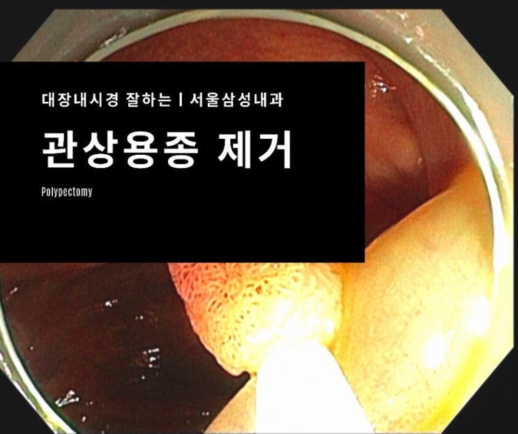 출혈 위험으로 타원에서 의뢰된 용종제거 1례- 광주대장내시경 서울삼성내과