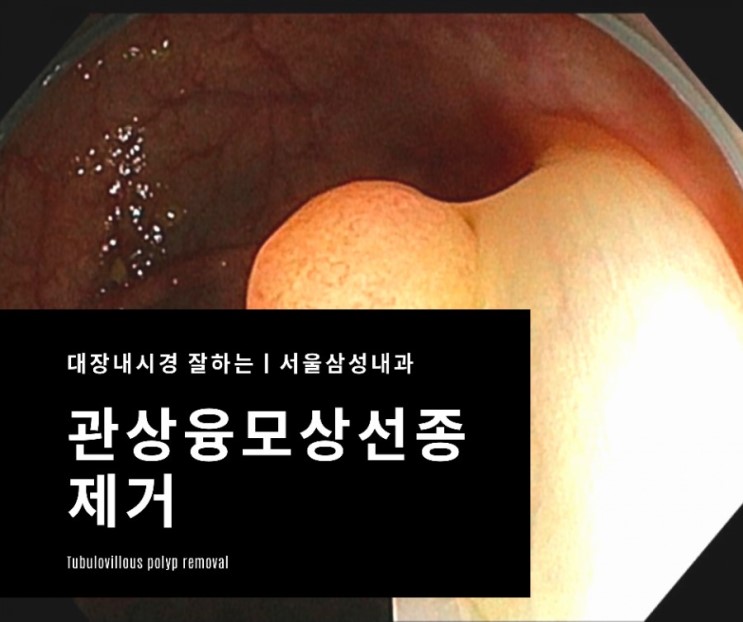 분변검사(혈변) 이상으로 시행한 용종제거 1례- 광주대장내시경 서울삼성내과