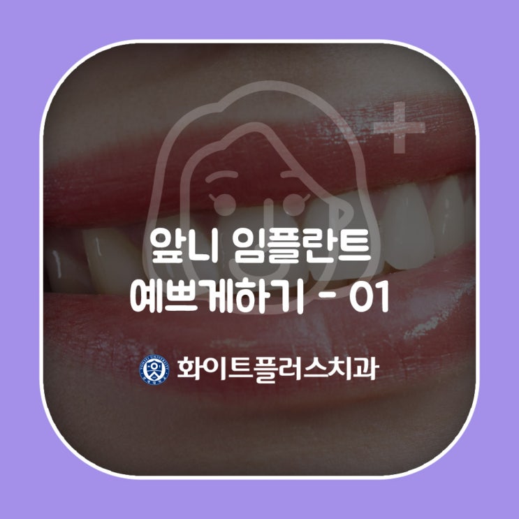  [신풍역치과] 앞니 임플란트 예쁘게하기 -1