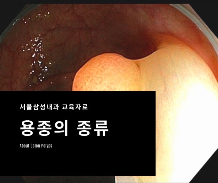  대장내시경에서 발견되는 용종의 종류와 용종절제 필요성에 대한 교육자료 - 광주 대장내시경 잘하는 서울삼성내과