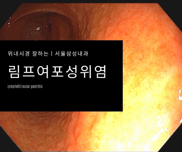  윗배답답, 소화불량, 미식거림, 잦은트름으로 시행한 내시경에서 진단된 림프여포성 위염 1례 - 광주에서 위내시경 잘하는 서울삼성내과