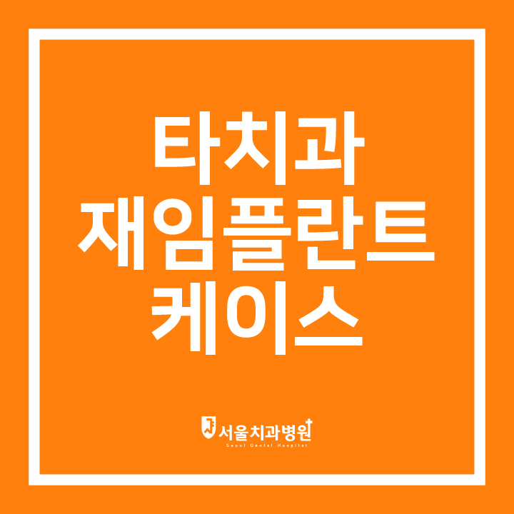  [용전동 서울치과] 임플란트 치료 : 타치과 재임플란트 케이스