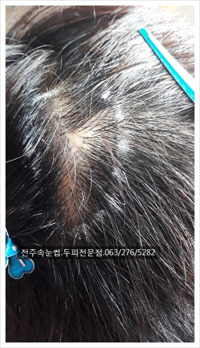 수술흉터고민~ #전주두피타투 대박!! 수술흉터고민~ #전주두피타투 대박!!