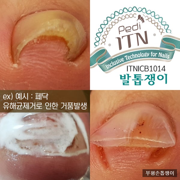 문제성 발톱 내성발톱 교정은 인천 부평 페디아이티엔에서 상담받으세요~