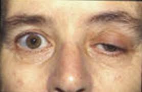  중증근무력증 의료 칸나비스 연구 개요 MYASTHENIA GRAVIS – MEDICAL MARIJUANA RESEARCH OVERVIEW