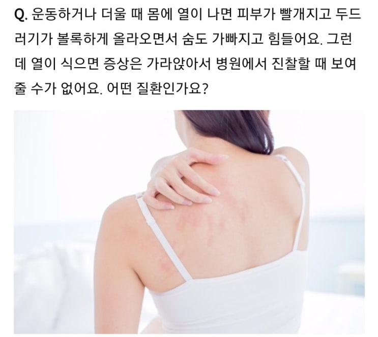  콜린성두드러기 나도 있는것/교회서 싫은기자하고 밥 같이 안먹기 성공