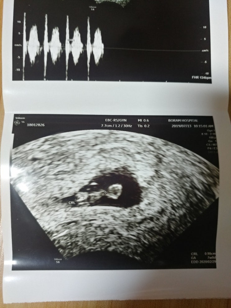 초음파사진 용어정리 초음파사진 용어정리