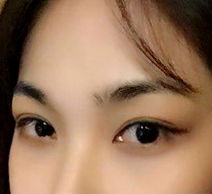  강남눈트임성형 시원한 눈매로 몽고주름제거