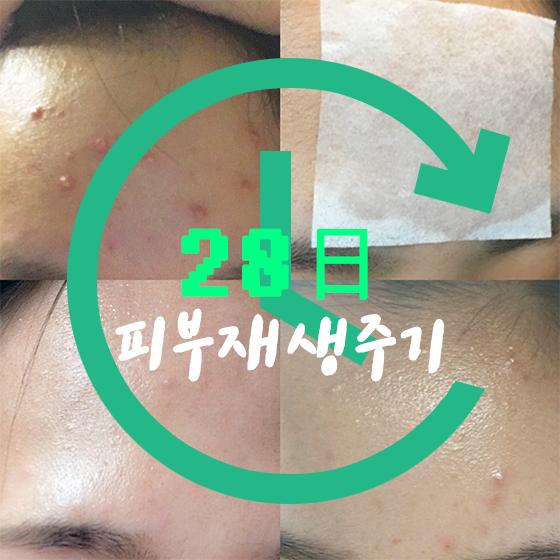  여드름 흉터 크림 피부재생주기 200% 활용하는 방법
