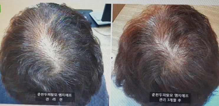  노후를  보다 건강하고 멋지게..!!  두피관리가 무엇보다 중요해요 ~