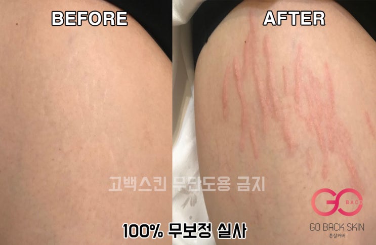  [고백스킨] 튼살타투 살색타투 허벅지 튼살 타투 전체시술 직후 과정 및 소개