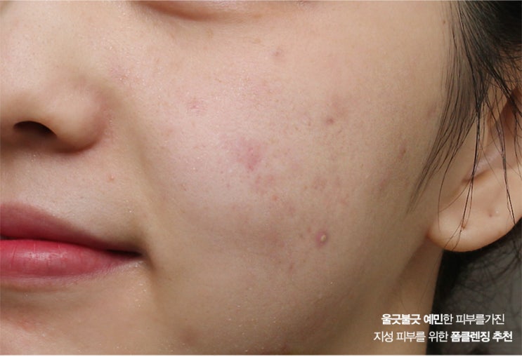  지성피부 폼클렌징 유분폭발 트러블피부 주목