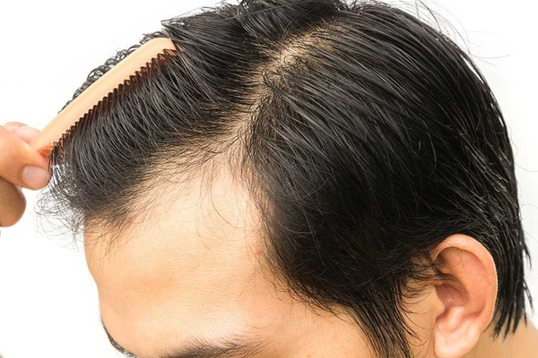 탈모 모발이식과 헤어라인교정의 모든 것에 대해서 파헤치고 두피관리 방법 배워가기! 탈모 모발이식과 헤어라인교정의 모든 것에 대해서 파헤치고 두피관리 방법 배워가기!