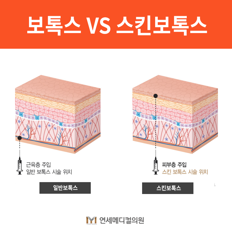 스킨보톡스 유지기간 효과 오래 유지하는 방법 3